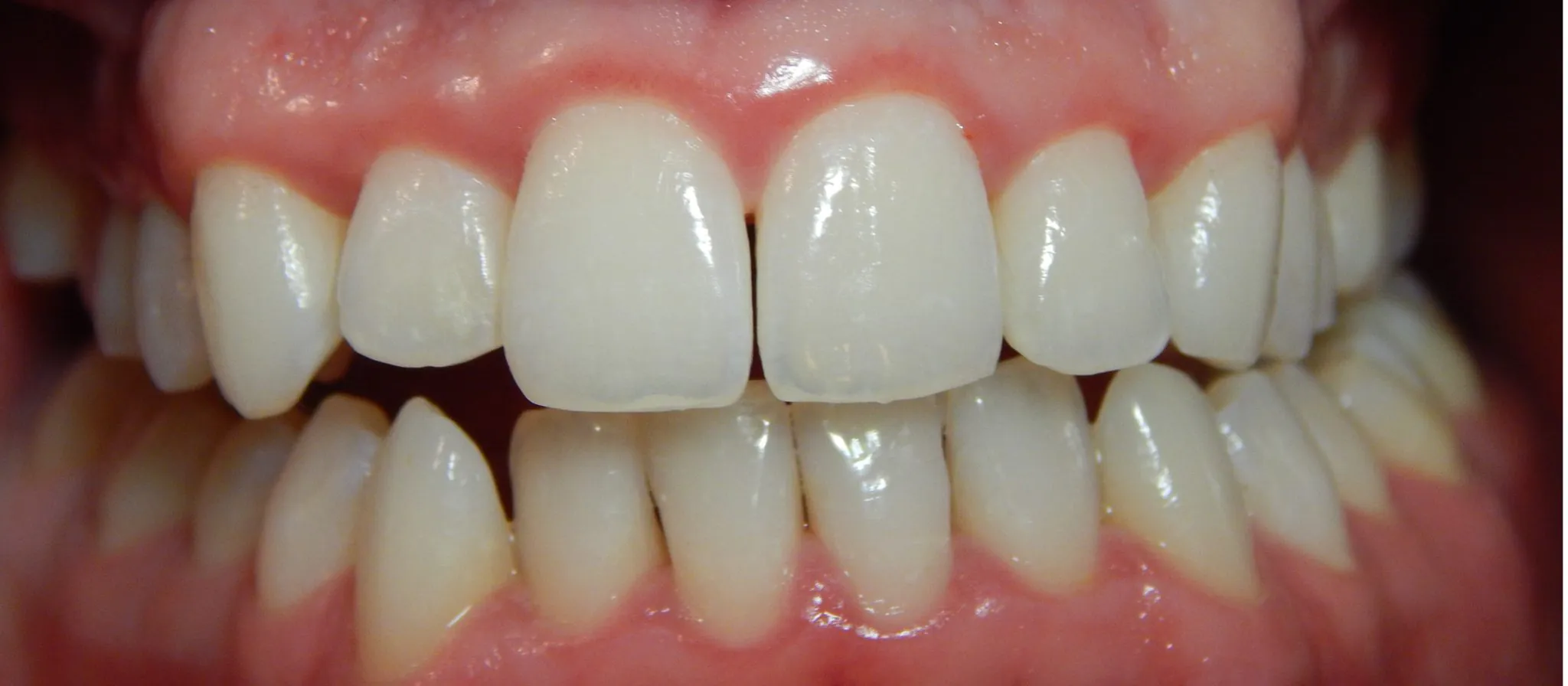 semaglutide bleeding gums Why Are My Bleeding? 9 Common Causes and Solutions Ozempic and Your Teeth: What Bleeding Gums in Pensacola, FL