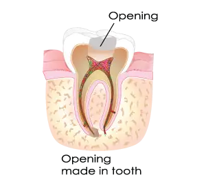 Root Canals Phoenix Ahwatukee AZ - Imagine Dental